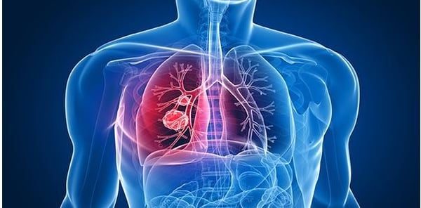 pulmones